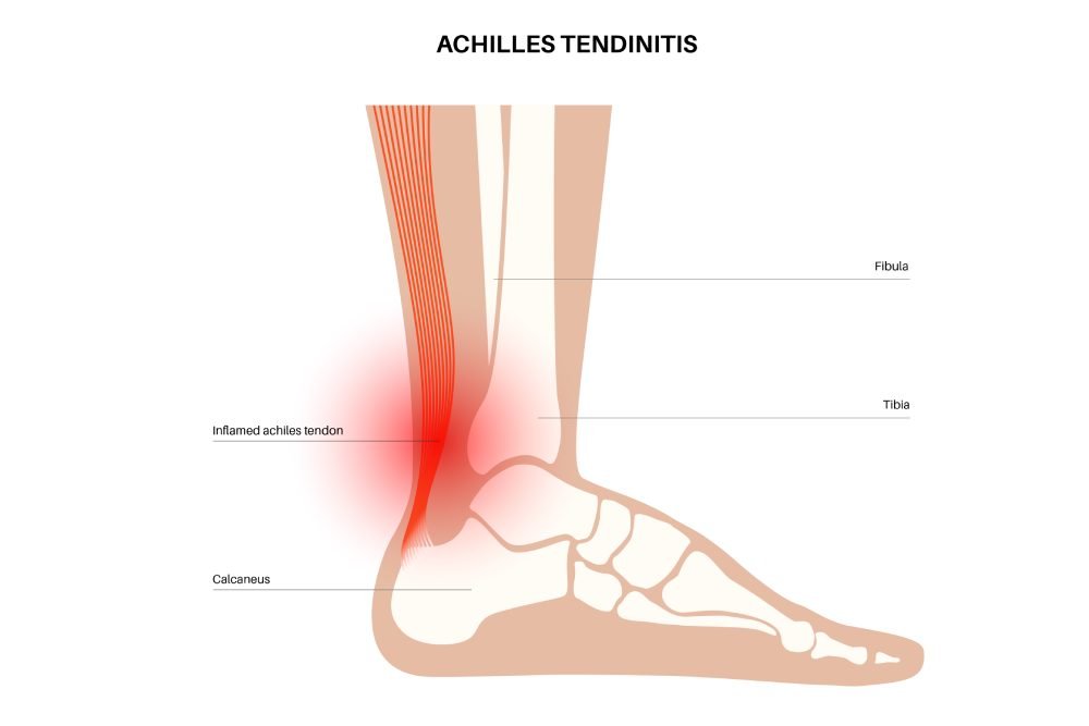Achilles Tendinitis