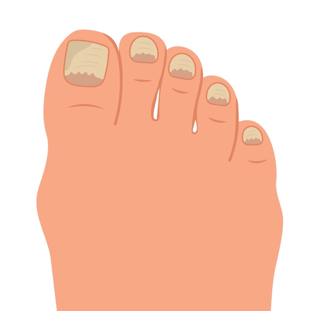 Toenail fungus/ Conditions