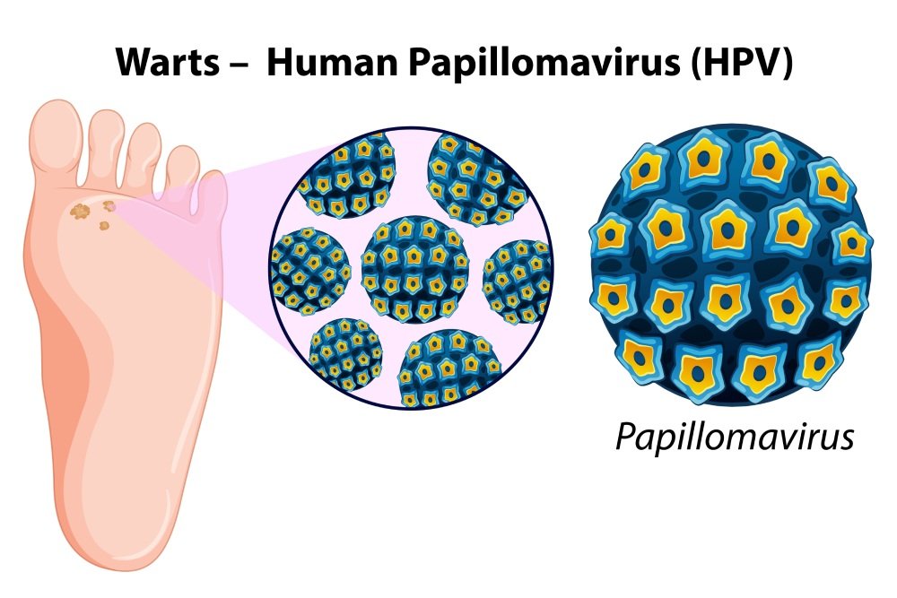 Warts